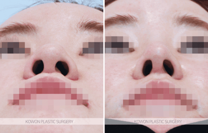 코수술 10년이 지나면 재수술이 필수인가요 — 보형물 교체를 판단하는 기준 관련 이미지 5/8
