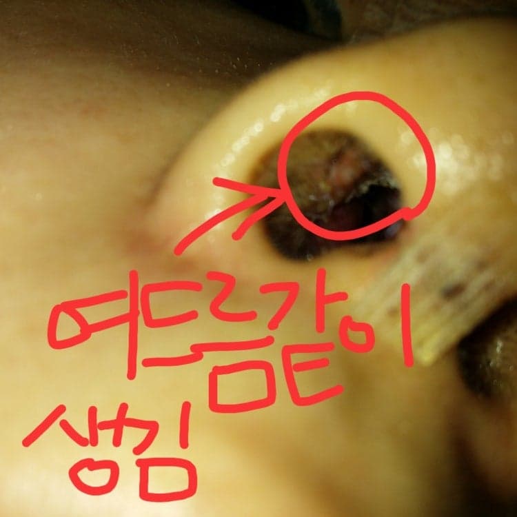코수술 2주 뒤 코안에 생긴 여드름, 염증일까요? — 병원에 확인해야 하는 신호 관련 이미지 3/3