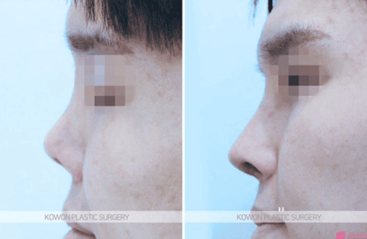코성형 1년 뒤 여드름을 짠 후 통증이 생겼다면 — 코 주변을 함부로 짜면 안 되는 이유 관련 이미지 4/5