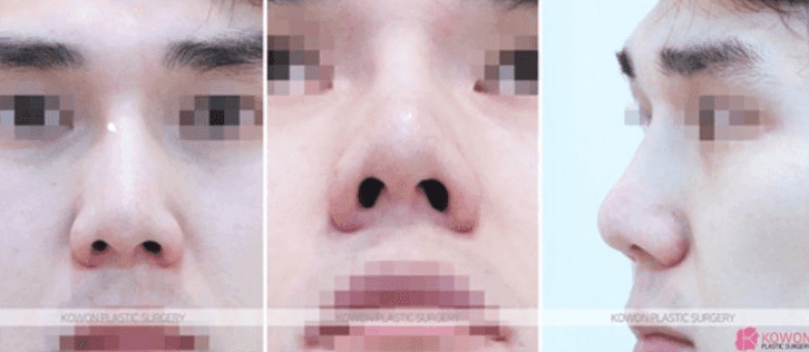 코수술 열흘 뒤 코끝이 내려앉았다면 — 실 풀림·기증 늑연골 상태와 재건수술 판단 관련 이미지 5/11