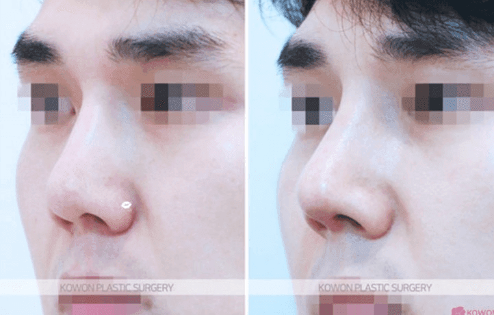 코수술 열흘 뒤 코끝이 내려앉았다면 — 실 풀림·기증 늑연골 상태와 재건수술 판단 관련 이미지 8/11