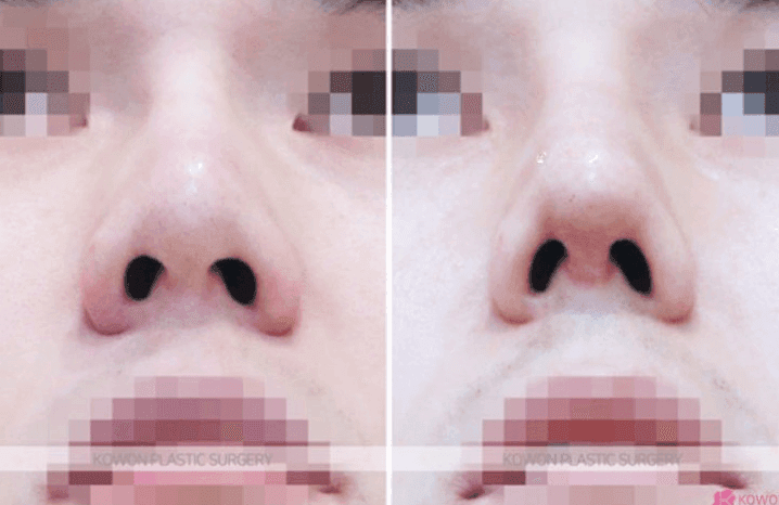 코수술 열흘 뒤 코끝이 내려앉았다면 — 실 풀림·기증 늑연골 상태와 재건수술 판단 관련 이미지 9/11