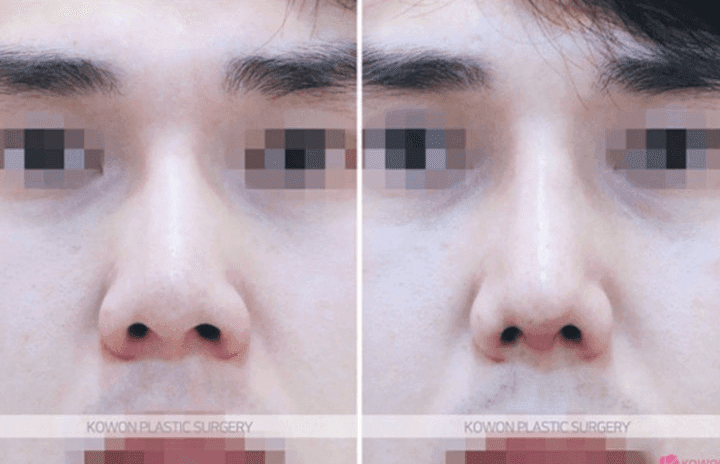 코수술 열흘 뒤 코끝이 내려앉았다면 — 실 풀림·기증 늑연골 상태와 재건수술 판단 관련 이미지 10/11