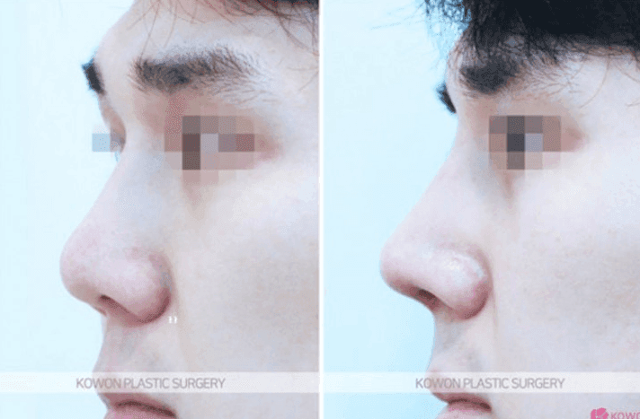코수술 열흘 뒤 코끝이 내려앉았다면 — 실 풀림·기증 늑연골 상태와 재건수술 판단 관련 이미지 11/11