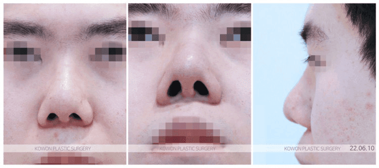 코재수술비용, 결정 전 꼭 확인할 것들 — 비용 차이의 네 가지 요인과 진단의 순서 관련 이미지 3/6