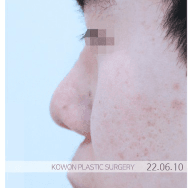 코재수술비용, 결정 전 꼭 확인할 것들 — 비용 차이의 네 가지 요인과 진단의 순서 관련 이미지 4/6