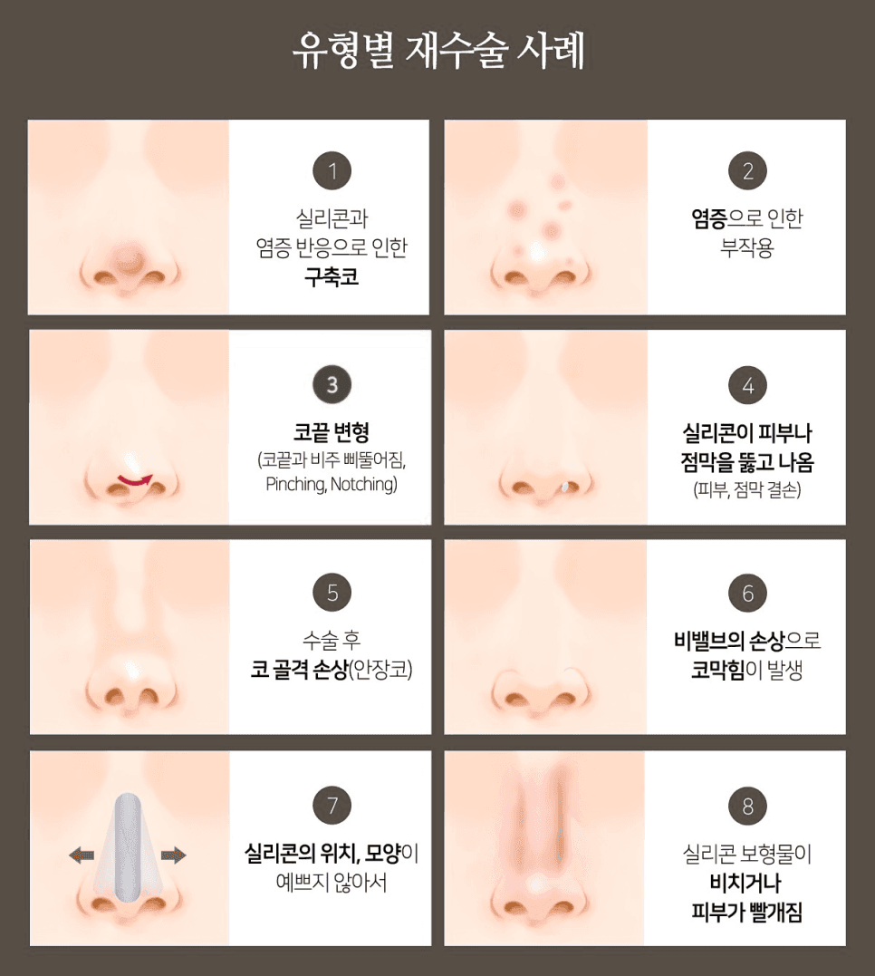 코재수술 결정 전 확인해야 할 포인트 — 원인 분석·접근 방식·얼굴 조화 관련 이미지 2/6