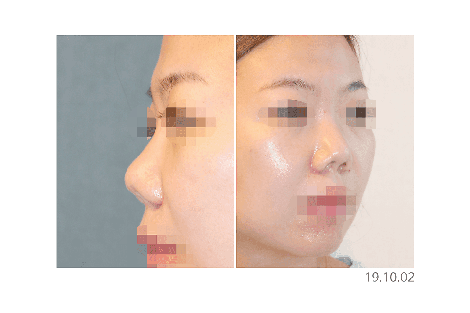 코재수술 결정 전 확인해야 할 포인트 — 원인 분석·접근 방식·얼굴 조화 관련 이미지 4/6