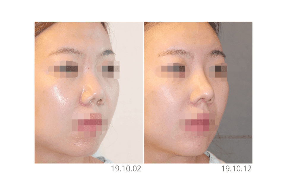 코재수술 결정 전 확인해야 할 포인트 — 원인 분석·접근 방식·얼굴 조화 관련 이미지 6/6