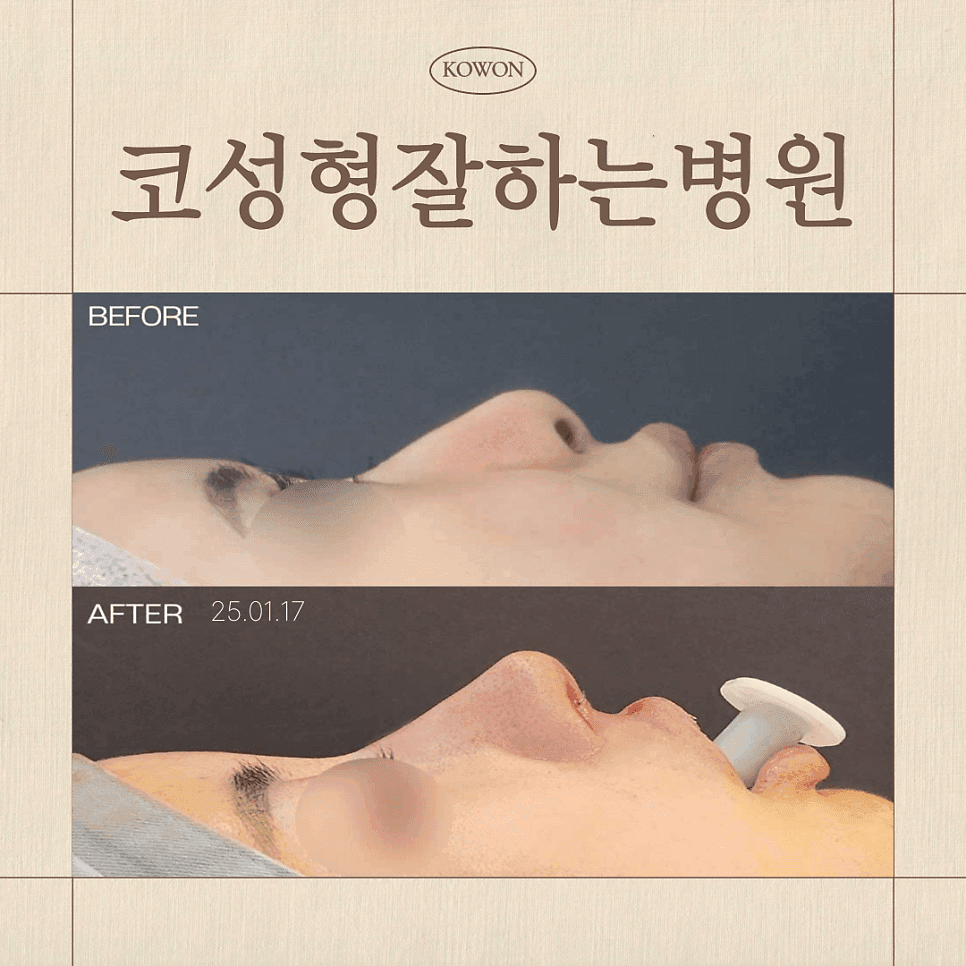 코 재수술에서 무보형물 수술을 검토하는 기준 — 실패가 반복되는 진짜 원인부터 관련 이미지 1/7
