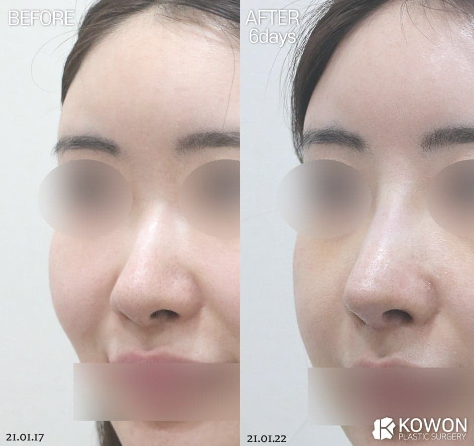 코 재수술에서 무보형물 수술을 검토하는 기준 — 실패가 반복되는 진짜 원인부터 관련 이미지 6/7