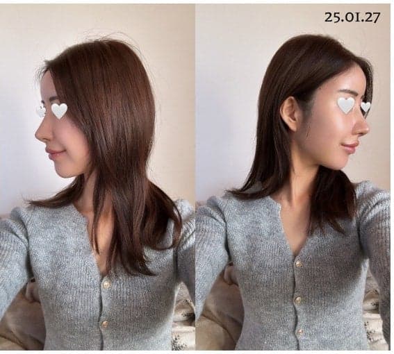 코 재수술에서 무보형물 수술을 검토하는 기준 — 실패가 반복되는 진짜 원인부터 관련 이미지 7/7