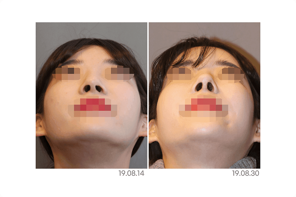 코재수술 상담 전 확인 — 붓기인지 구조 문제인지 구분하는 기준과 재료 선택 관련 이미지 3/7