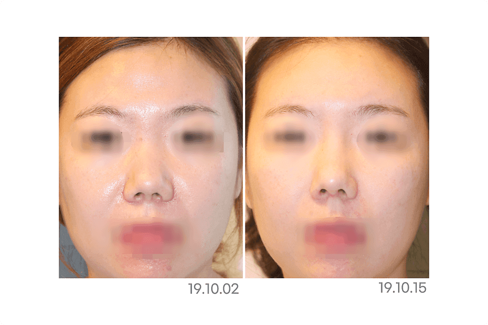 코재수술, 시간이 지나 다시 신경 쓰인다면 — 지켜볼 변화와 점검할 신호 구분하기 관련 이미지 3/8