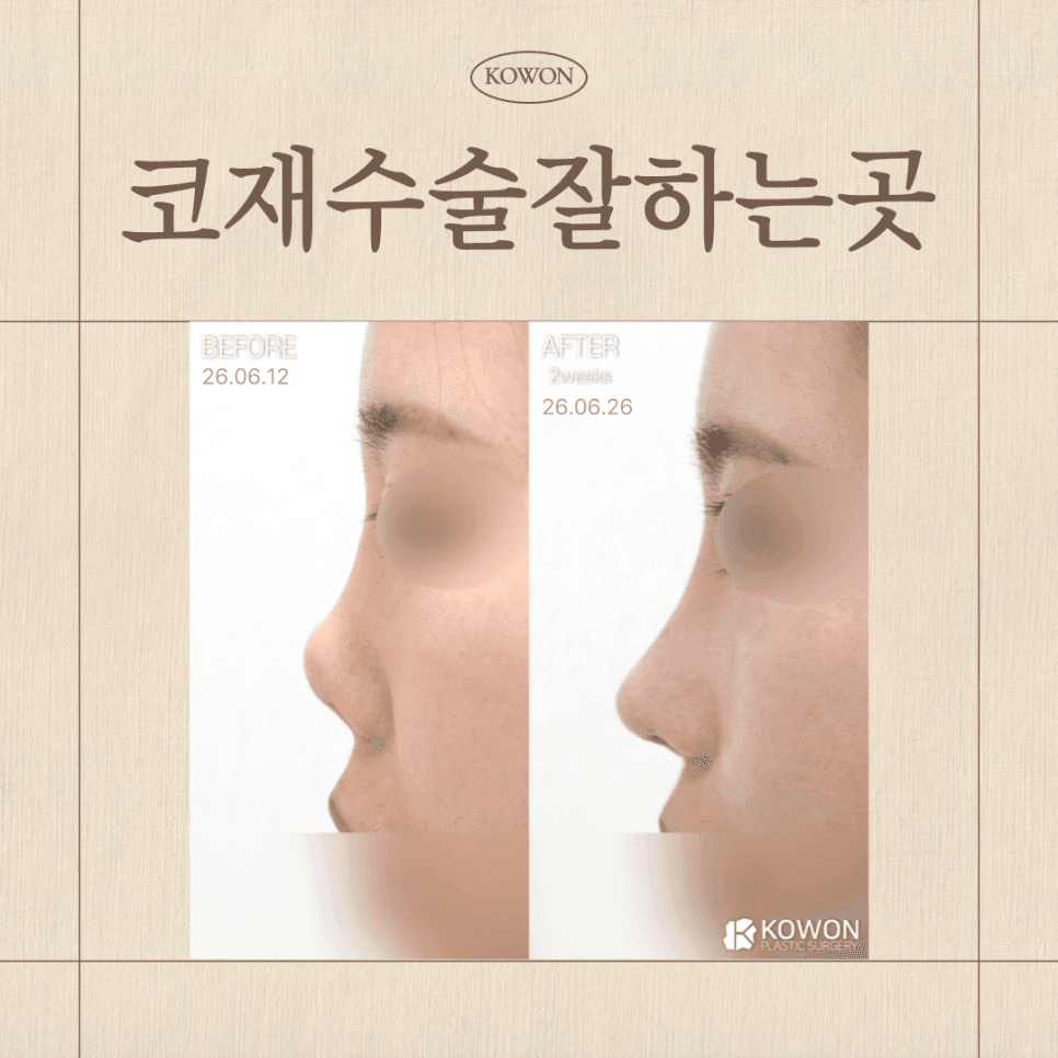 ปลายจมูกยกสูง: เป็นสัญญาณของการผ่าตัดแก้ไขหรือไม่? — สาเหตุ โครงสร้าง และเกณฑ์สำหรับการผ่าตัดแก้ไขปลายจมูกภาพประกอบ 1/4