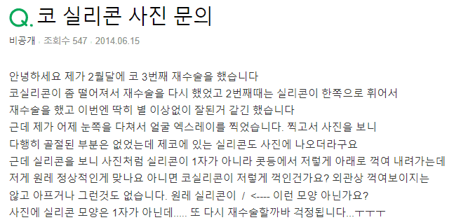 코수술 후 엑스레이에서 코 실리콘이 꺾여 보인다면 — 정상 범위를 구분하는 기준 관련 이미지 2/3