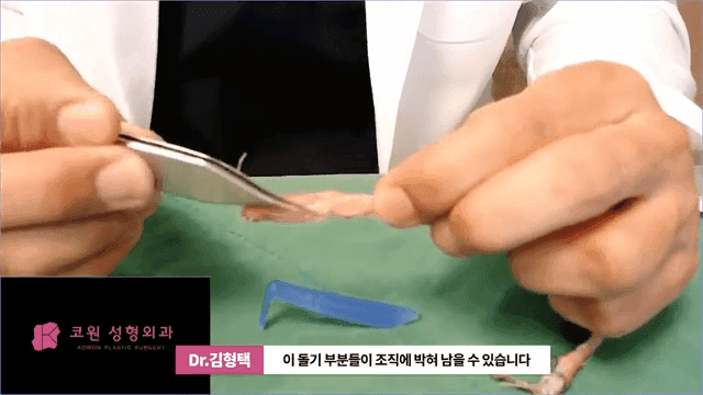 하이코 실리프팅 실제거, 실을 한꺼번에 제거하는 것이 좋은 세 가지 이유 관련 이미지 4/17
