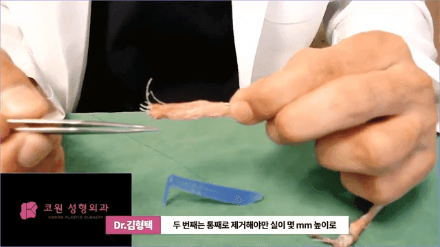 하이코 실리프팅 실제거, 실을 한꺼번에 제거하는 것이 좋은 세 가지 이유 관련 이미지 6/17