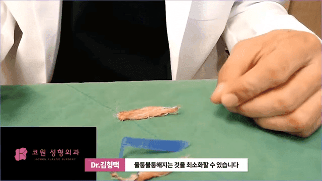하이코 실리프팅 실제거, 실을 한꺼번에 제거하는 것이 좋은 세 가지 이유 관련 이미지 11/17
