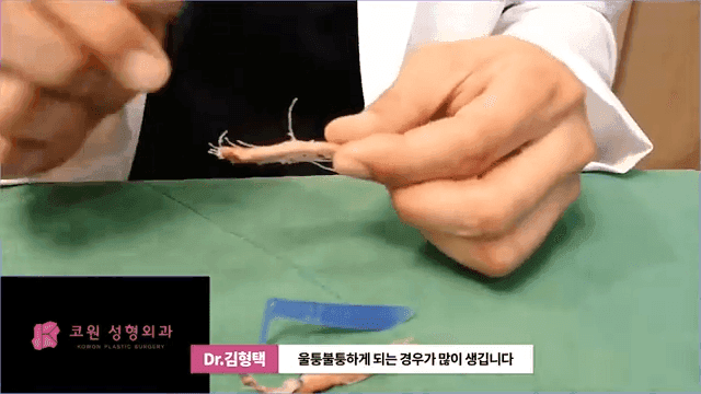 하이코 실리프팅 실제거, 실을 한꺼번에 제거하는 것이 좋은 세 가지 이유 관련 이미지 13/17