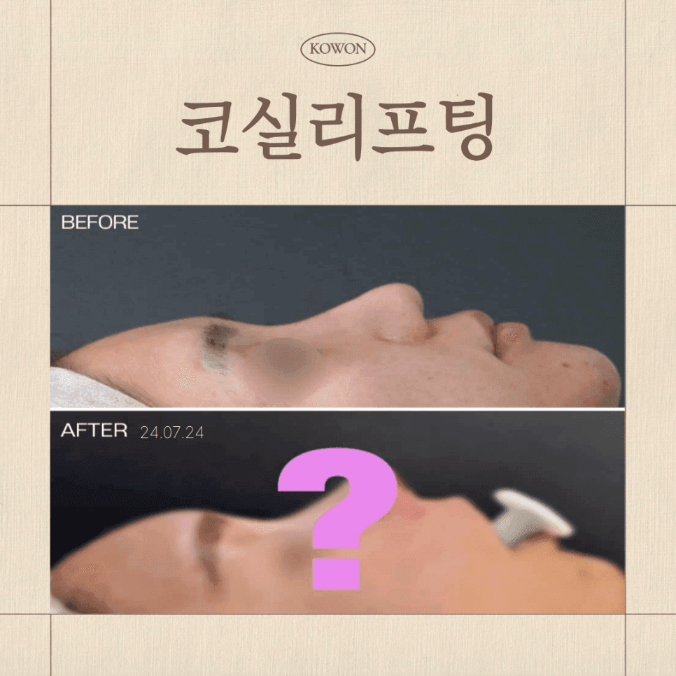 코실리프팅, 왜 넣기보다 제거가 어려울까 — 부작용과 결정 전 확인할 것 관련 이미지 1/3