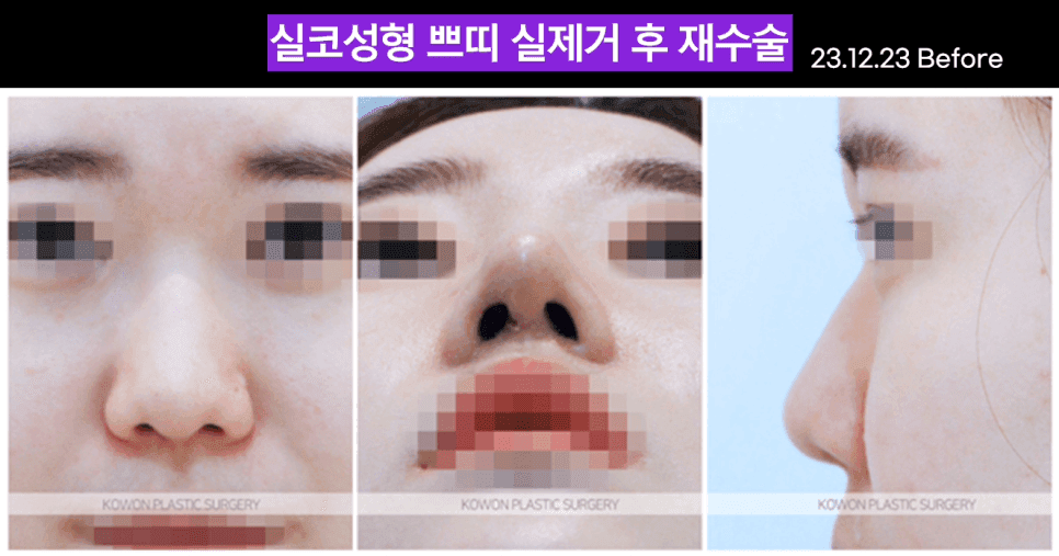 코실 제거, 왜 그냥 뽑으면 안 될까 — 남는 흉살과 제거 후 재건까지 보는 이유 관련 이미지 2/5