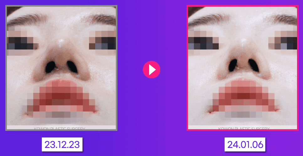 코실 제거, 왜 그냥 뽑으면 안 될까 — 남는 흉살과 제거 후 재건까지 보는 이유 관련 이미지 3/5