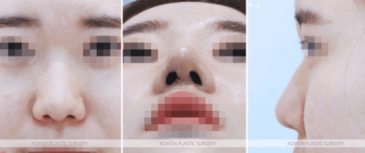 หากคุณรู้สึกว่าปลายจมูกยุบลงหลังจากผ่าตัดไปแล้วหนึ่งปีครึ่ง — การระบุสาเหตุและช่วงเวลาที่เหมาะสมสำหรับการผ่าตัดแก้ไข และกรณีศึกษาเกี่ยวกับการยกกระชับจมูกด้วยไหม (ภาพประกอบ 4/10)