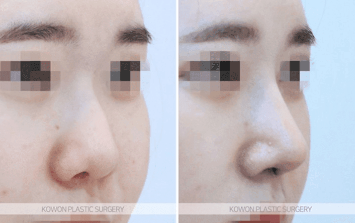 Image 7/10 for: tip collapse after surgery — revision cause and timing