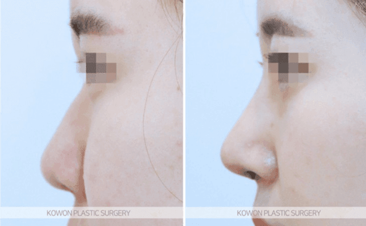 Image 8/10 for: tip collapse after surgery — revision cause and timing