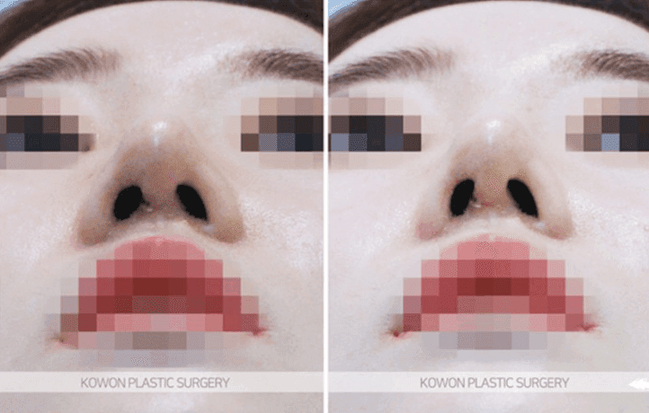 Image 10/10 for: tip collapse after surgery — revision cause and timing