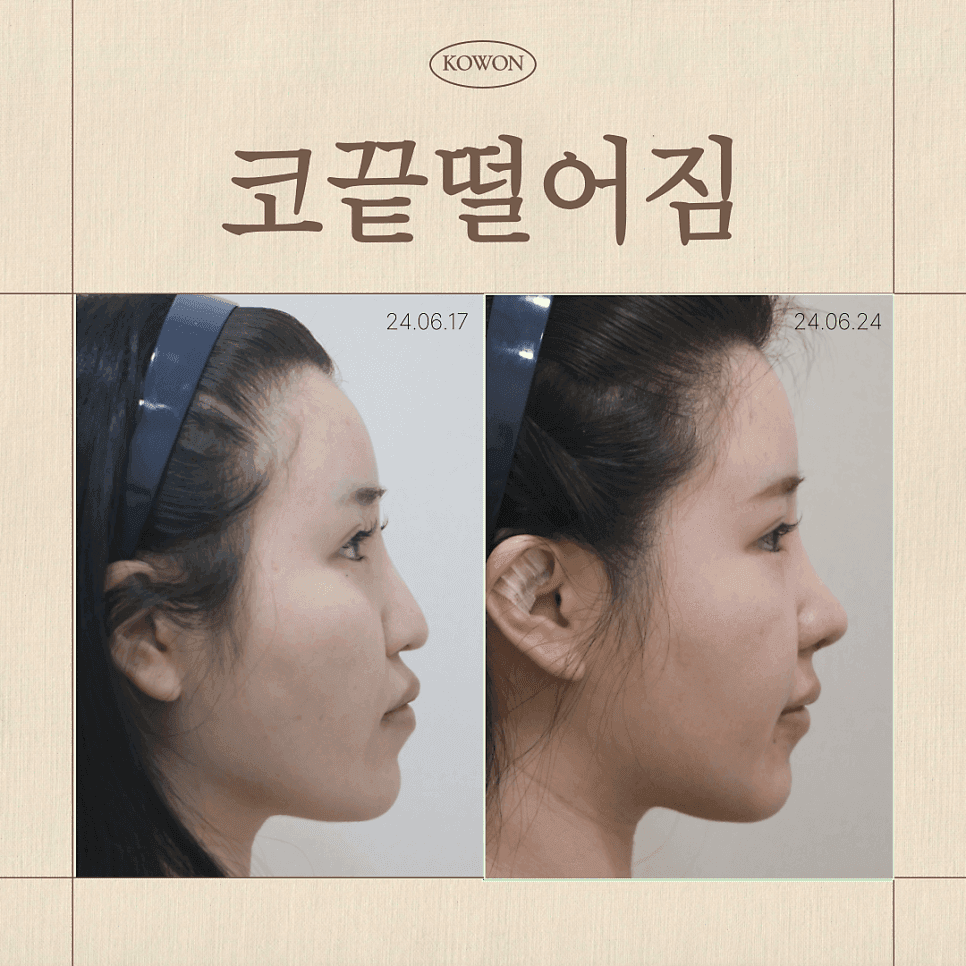 코끝떨어짐, 코끝성형 후 처지는 느낌은 정상일까 — 구조 변화 구분과 지지력 확인 관련 이미지 1/7