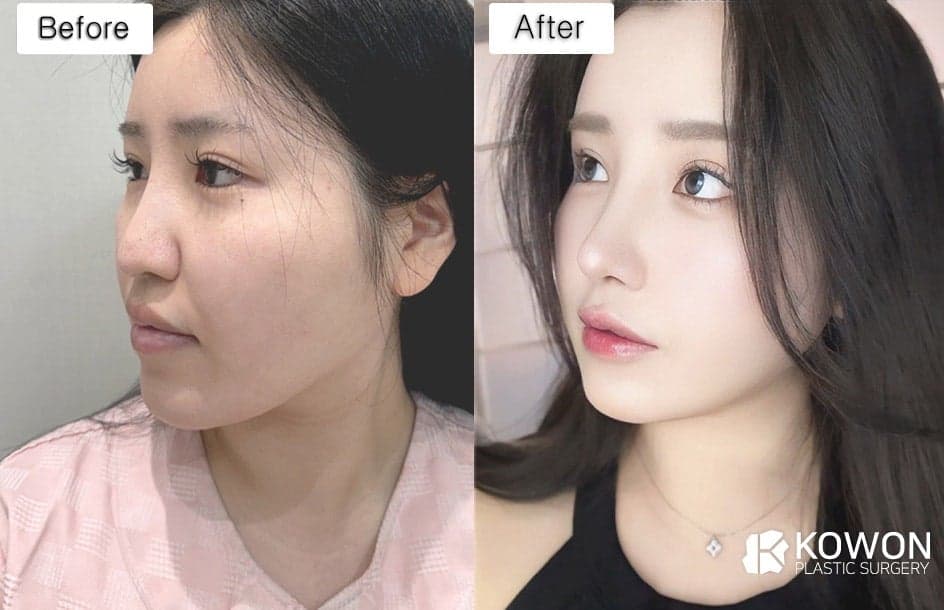 코끝떨어짐, 코끝성형 후 처지는 느낌은 정상일까 — 구조 변화 구분과 지지력 확인 관련 이미지 6/7