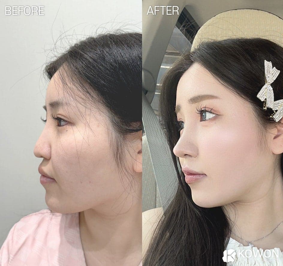 코끝떨어짐, 코끝성형 후 처지는 느낌은 정상일까 — 구조 변화 구분과 지지력 확인 관련 이미지 7/7