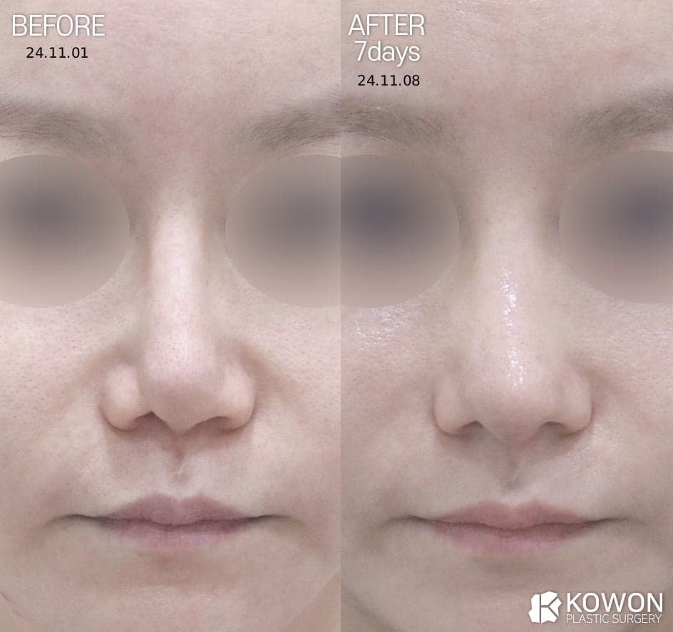 코끝염증, 방치하면 어떻게 되나 — 초기 신호와 코끝재수술을 고려하는 기준 관련 이미지 8/8