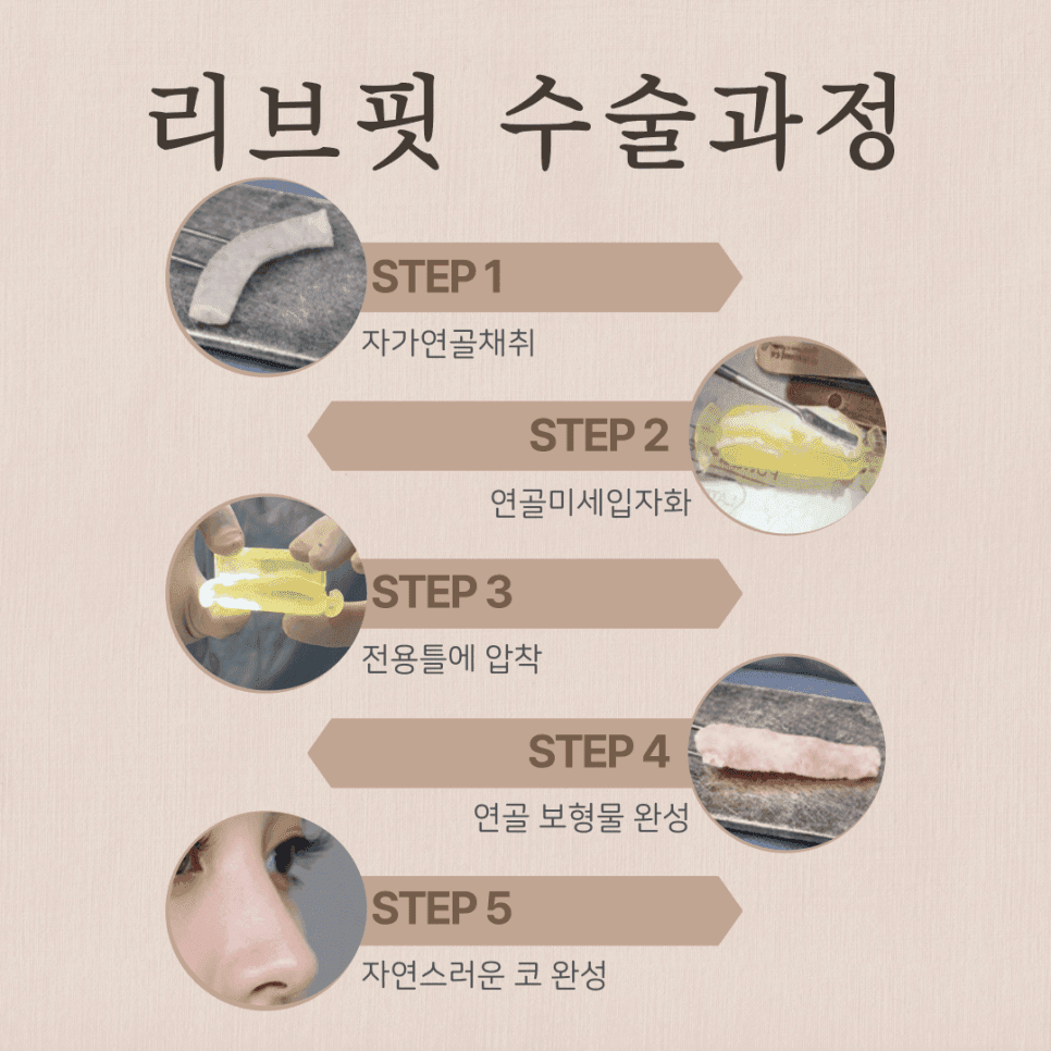 อาการปวดปลายจมูกเกิดการอักเสบหรือไม่? — เกณฑ์ในการพิจารณาว่าควรศัลยกรรมแก้จมูกหรือไม่นั้น ไม่ใช่ความเจ็บปวด แต่เป็นภาพถ่ายที่เกี่ยวข้องกับการเปลี่ยนแปลงรูปทรง 5/6