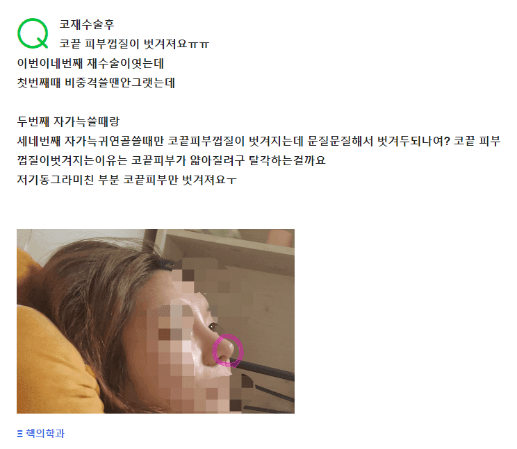 코재수술 후 코끝 피부 각질이 벗겨져요 — 자가늑 때문일까요? 관련 이미지 2/2