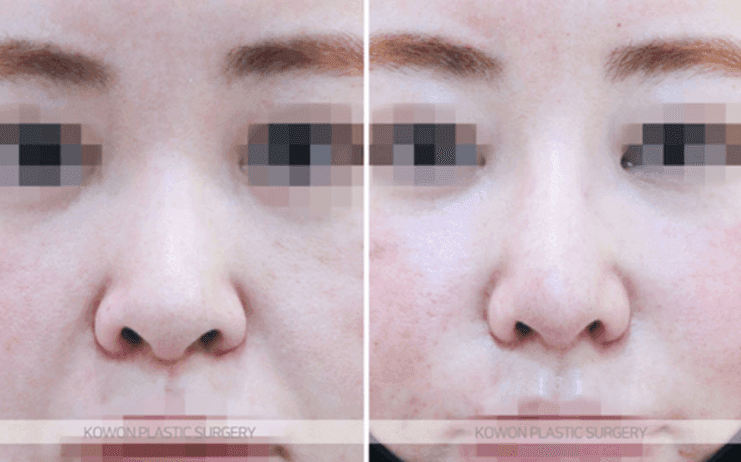 코수술 2주, 코끝이 새 부리처럼 보여요 — 붓기가 더 빠지길 기다릴지, 재수술을 준비할지 관련 이미지 3/10