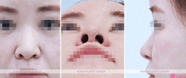 코수술 2주, 코끝이 새 부리처럼 보여요 — 붓기가 더 빠지길 기다릴지, 재수술을 준비할지 관련 이미지 4/10