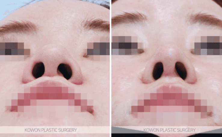 코수술 2주, 코끝이 새 부리처럼 보여요 — 붓기가 더 빠지길 기다릴지, 재수술을 준비할지 관련 이미지 5/10