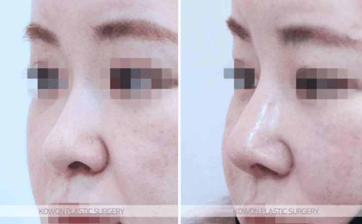 코수술 2주, 코끝이 새 부리처럼 보여요 — 붓기가 더 빠지길 기다릴지, 재수술을 준비할지 관련 이미지 8/10