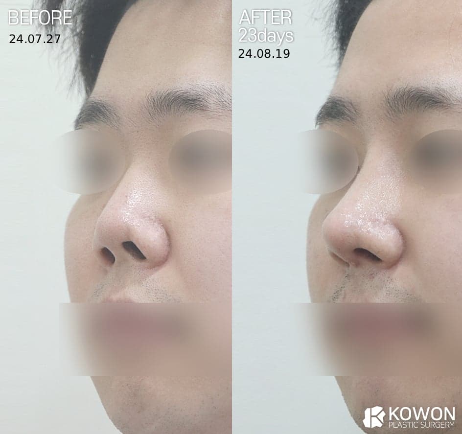 콧구멍 짝짝이, 정상인가요? — 비대칭의 세 가지 원인과 확인 순서 관련 이미지 2/3