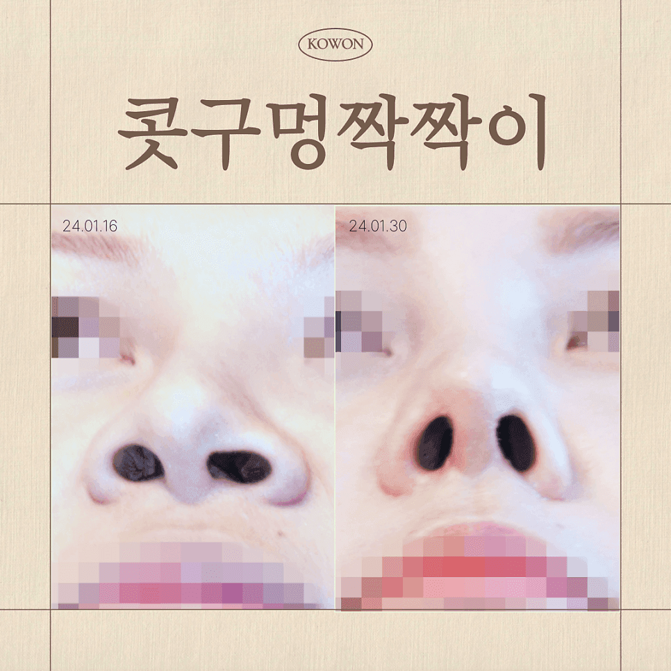 콧구멍 비대칭, 언제까지 지켜보고 언제 점검해야 할까 — 시기별 기준과 체크리스트 관련 이미지 1/8
