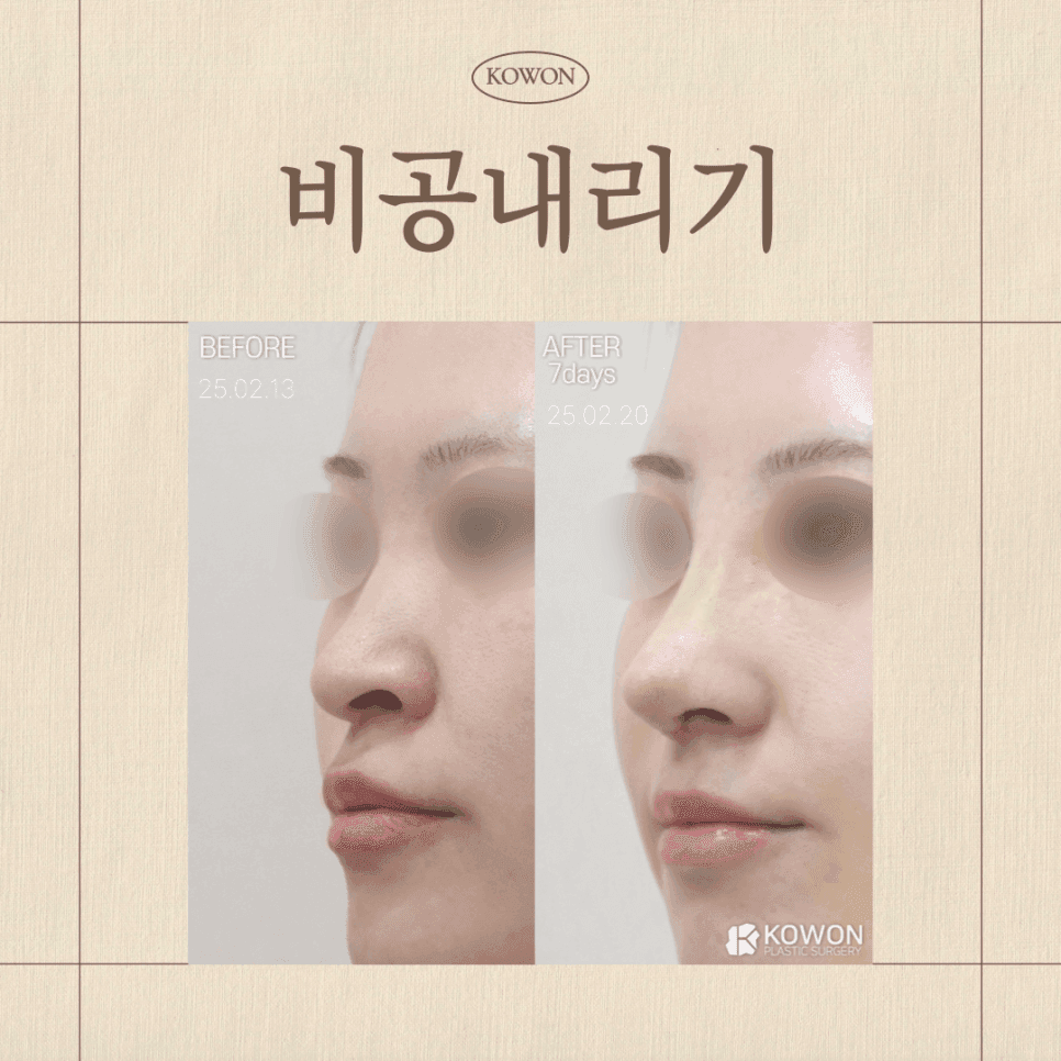 การลดขอบรูจมูกลง จมูกเชิดและยงโคคืออะไร? — จากการจำแนกประเภทไปจนถึงทิศทางการผ่าตัด ภาพที่เกี่ยวข้อง 1/3