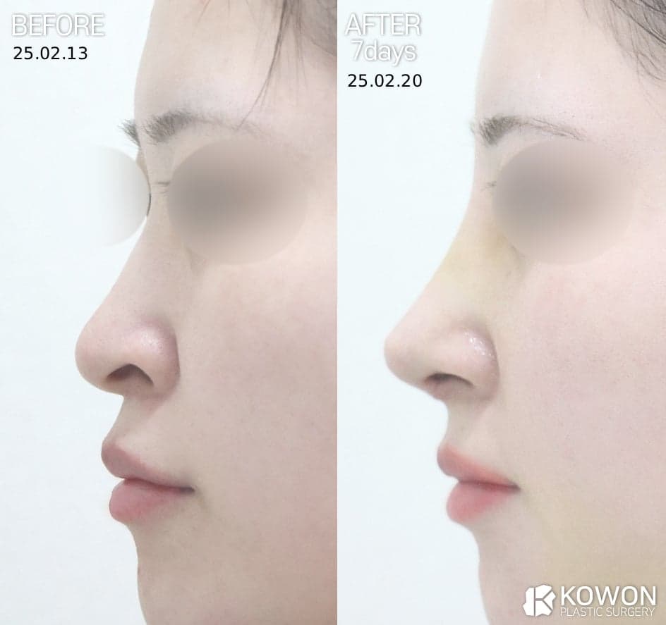 비공내리기, 들창코와 용코는 무엇이 다른가 — 유형 구분부터 수술 방향까지 관련 이미지 2/3