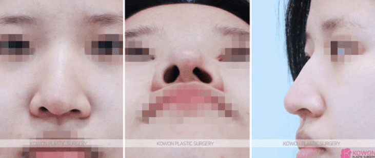 코수술 한달차 음주·흡연, 괜찮을까요? — 코끝 당김 증상을 보는 기준 관련 이미지 3/9