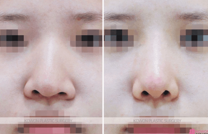 코수술 한달차 음주·흡연, 괜찮을까요? — 코끝 당김 증상을 보는 기준 관련 이미지 4/9