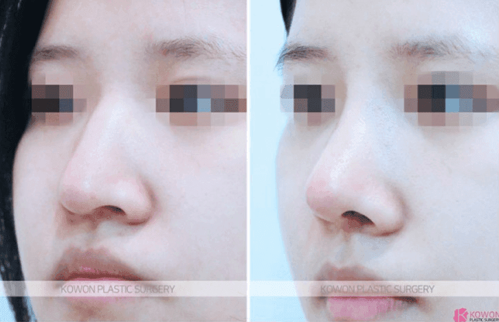 코수술 한달차 음주·흡연, 괜찮을까요? — 코끝 당김 증상을 보는 기준 관련 이미지 6/9