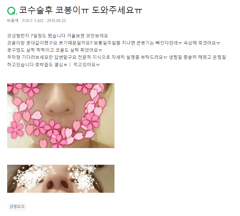 코수술 일주일차, 코봉이처럼 보이는 건 붓기 때문일까요 — 지금 판단이 어려운 이유 관련 이미지 2/2