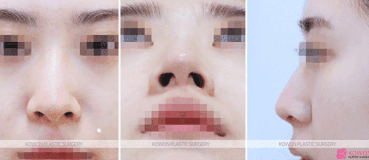 코절골술과 코끝 교정, 복코에는 어느 쪽이 맞을까 — 판단 기준과 실제 사례 관련 이미지 4/9